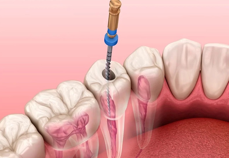 Tratament endodontic la microscop Dent For Life Cluj